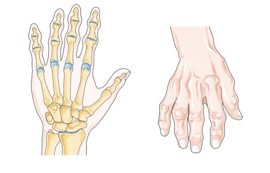 Åpnet møte Ottadalen Revmatikerlag
